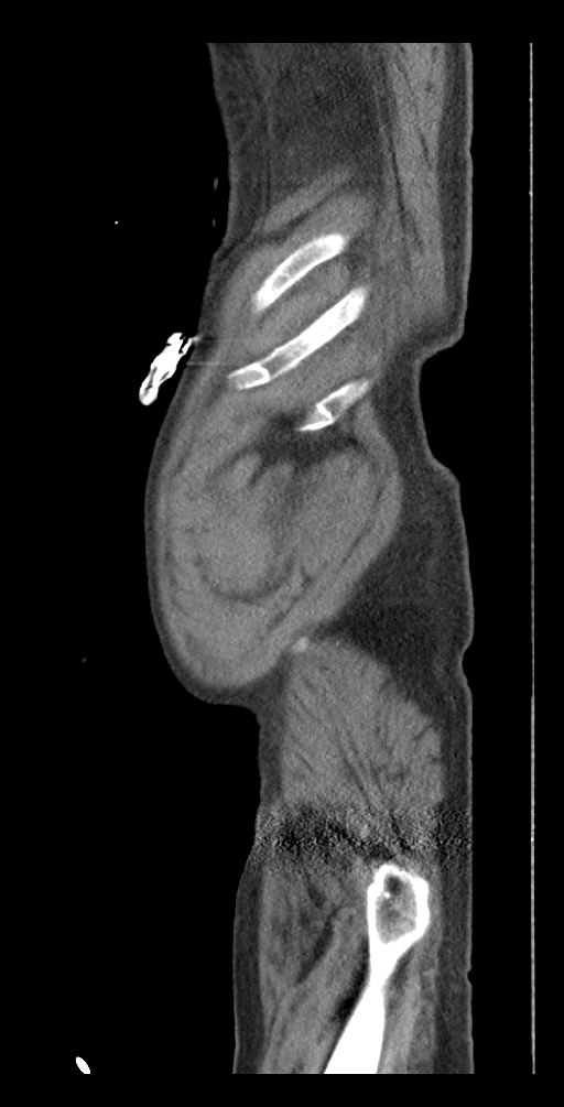Aortoduodenal fistula (Radiopaedia 75286-86415 Sagittal C+ delayed 62).jpg
