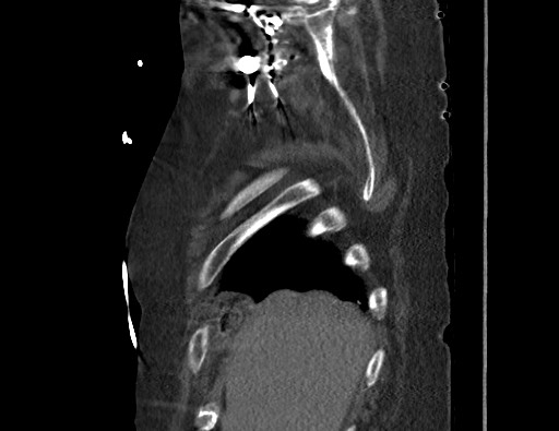 Aortoesophageal fistula with endovascular repair (Radiopaedia 73781-84592 Sagittal C+ CTPA 12).jpg