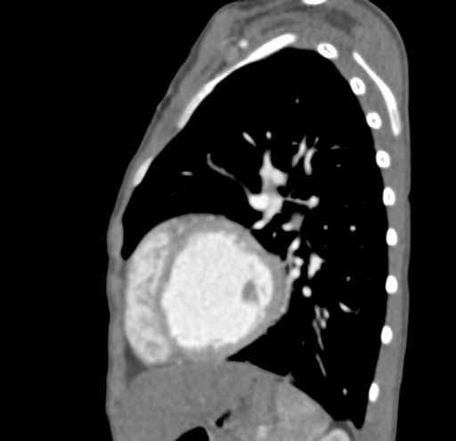 File:Aortopulmonary window, interrupted aortic arch and large PDA giving the descending aorta (Radiopaedia 35573-37074 C 40).jpg