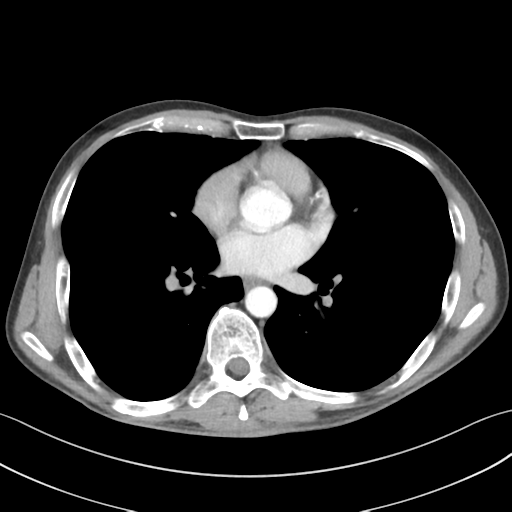 File:Apical pleural calcification (Radiopaedia 46141-50499 Axial C+ delayed 39).png