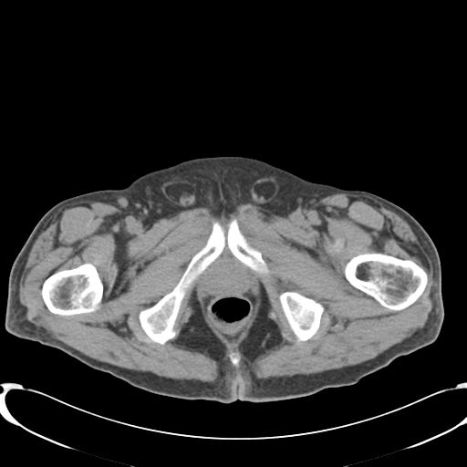 File:Appendiceal abscesses (Radiopaedia 50999-56542 Axial non-contrast 85).png
