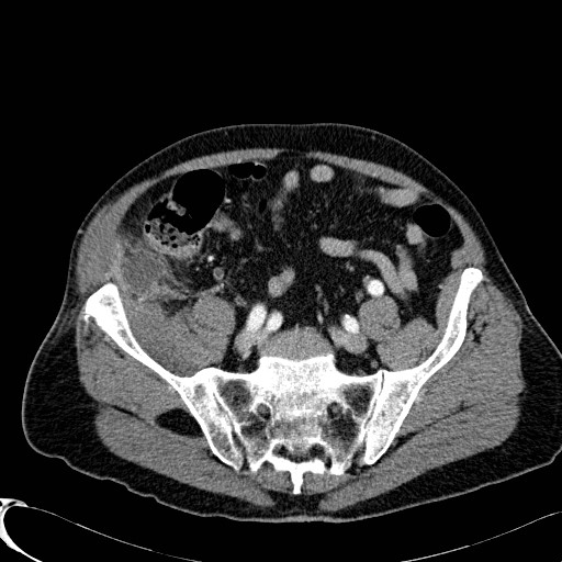 Appendiceal adenocarcinoma complicated by retroperitoneal abscess (Radiopaedia 58007-65039 B 106).jpg