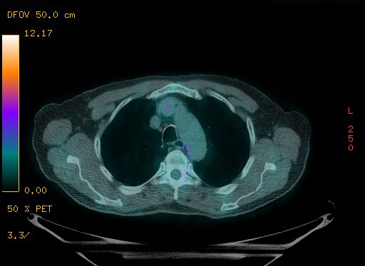 Appendiceal adenocarcinoma complicated by retroperitoneal abscess (Radiopaedia 58007-65041 Axial PET-CT 48).jpg