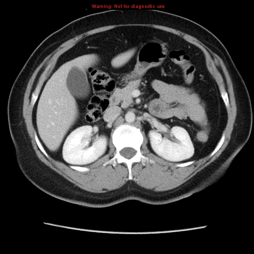 Appendiceal mucinous cystadenoma (Radiopaedia 8263-9111 Axial liver window 32).jpg