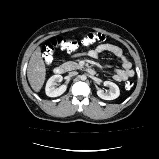 File:Appendicitis with diverticulosis (Radiopaedia 47693-52383 Axial C+ 54).jpg