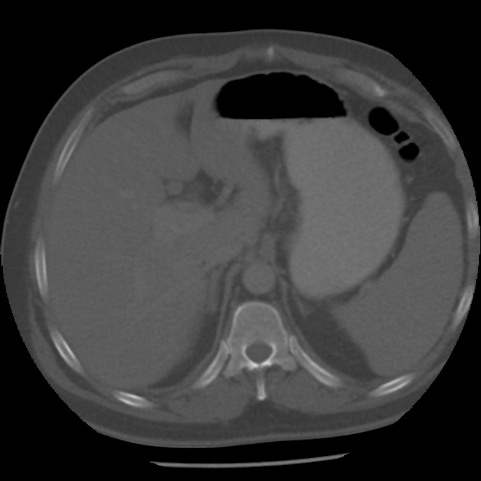 Appendicitis with perforation (Radiopaedia 35790-37342 Axial bone window 11).jpg