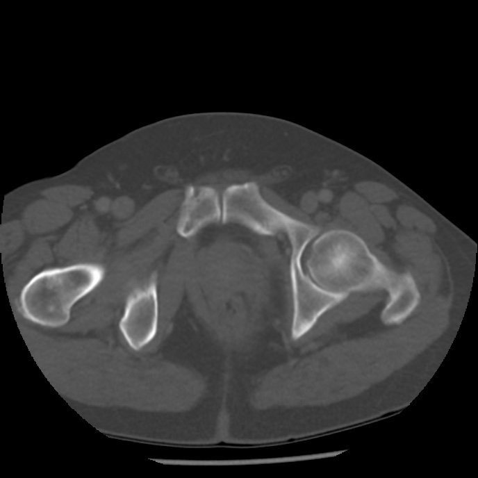Appendicitis with perforation (Radiopaedia 35790-37342 Axial bone window 53).jpg