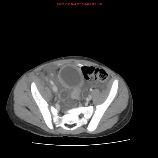 File:Appendicitis with phlegmon (Radiopaedia 9358-10046 A 56).jpg