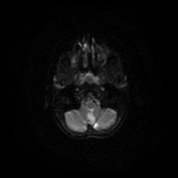 File:Arachnoid cyst - middle cranial fossa (Radiopaedia 86780-102938 Axial DWI 55).jpg