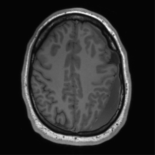 File:Arachnoid cyst with subdural hematoma (Radiopaedia 85892-101743 Axial T1 63).png