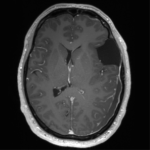 Arachnoid cyst with subdural hematoma (Radiopaedia 85892-101743 Axial T1 C+ 48).png