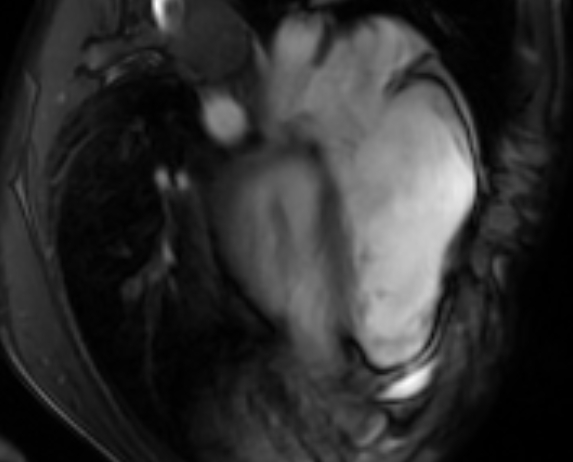 File:Arrhythmogenic right ventricular cardiomyopathy (Radiopaedia 69564-79464 4ch cine 102).jpg
