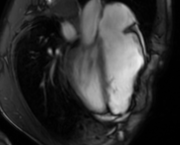 Arrhythmogenic right ventricular cardiomyopathy (Radiopaedia 69564-79464 4ch cine 90).jpg
