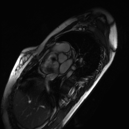 Arrhythmogenic right ventricular cardiomyopathy (Radiopaedia 87505-103850 short axis Cine SSFP 250).jpg