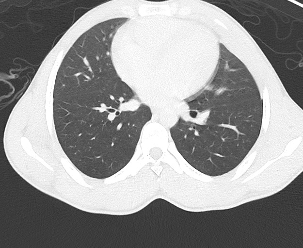 File:Arrow injury to the chest (Radiopaedia 75223-86321 Axial lung window 49).jpg