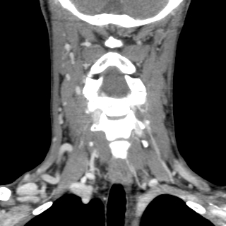 File:Arteriovenous malformation of the neck (Radiopaedia 53935-60062 D 12).jpg