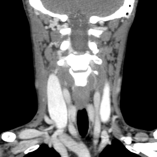 File:Arteriovenous malformation of the neck (Radiopaedia 53935-60062 D 2).jpg