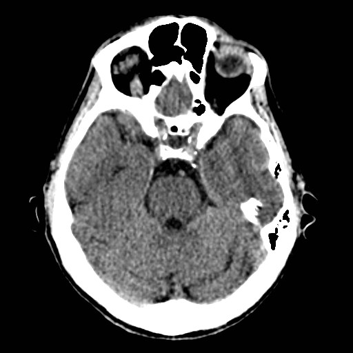 File:Artery of Percheron infarct (Radiopaedia 48088-52893 Axial non-contrast 13).jpg