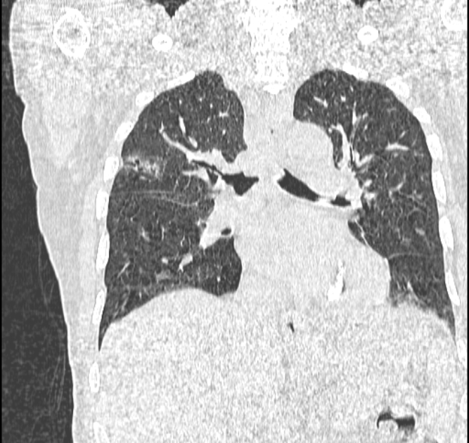 Aspergilloma (Radiopaedia 44592-48327 Coronal lung window 68).jpg