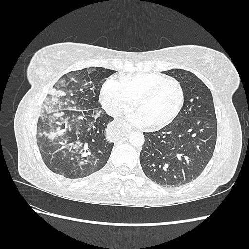 Aspiration pneumonia secondary to laparoscopic banding (Radiopaedia 18345-18183 lung window 76).jpg