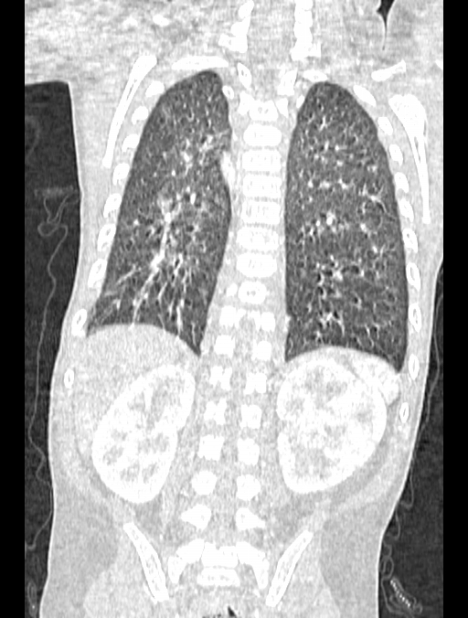 Asplenia syndrome (Radiopaedia 73083-83792 Coronal lung window 106).jpg