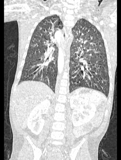 Asplenia syndrome (Radiopaedia 73083-83792 Coronal lung window 94).jpg