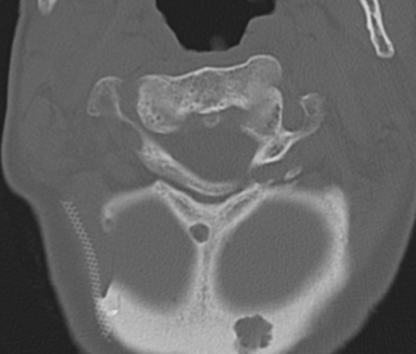 Atlanto-axial subluxation (Radiopaedia 36610-38176 Axial bone window 16).png