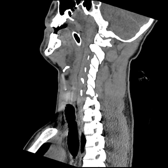 File:Atlanto-occipital dissociation (Traynelis type 1), C2 teardrop fracture, C6-7 facet joint dislocation (Radiopaedia 87655-104061 D 39).jpg