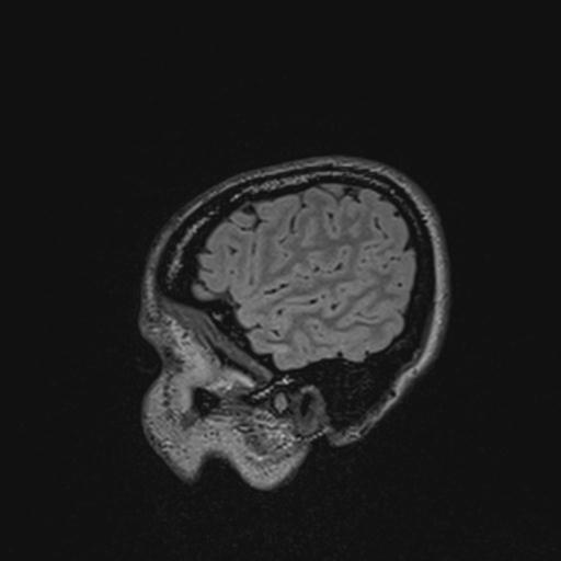 Atretic encephalocoele with inferior vermis hypoplasia (Radiopaedia 30443-31108 Sagittal FLAIR 31).jpg
