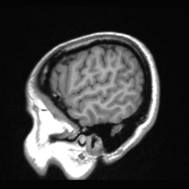 File:Atretic encephalocoele with inferior vermis hypoplasia (Radiopaedia 30443-31108 Sagittal T1 14).jpg