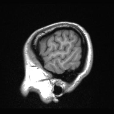 Atretic encephalocoele with inferior vermis hypoplasia (Radiopaedia 30443-31108 Sagittal T1 9).jpg