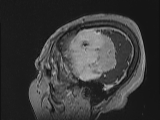 Atypical meningioma (Radiopaedia 62985-71406 Sagittal T1 C+ 88).jpg