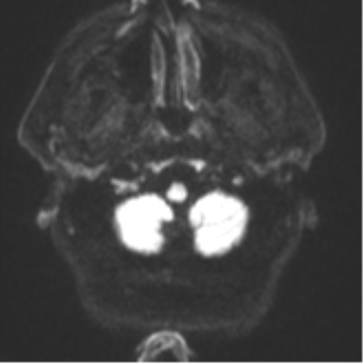 Atypical meningioma (WHO grade II) with brain invasion (Radiopaedia 57767-64729 Axial DWI 33).png