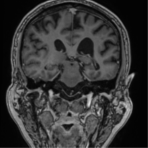 Atypical meningioma (WHO grade II) with brain invasion (Radiopaedia 57767-64729 Coronal T1 C+ 49).png