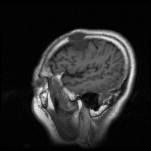 File:Atypical meningioma (WHO grade II) with osseous invasion (Radiopaedia 53654-59716 Sagittal T1 19).png