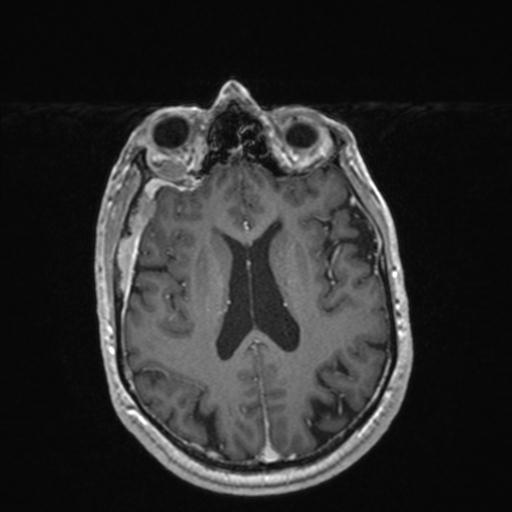 Atypical meningioma (grade II) - en plaque (Radiopaedia 29633-30147 Axial T1 C+ 115).jpg