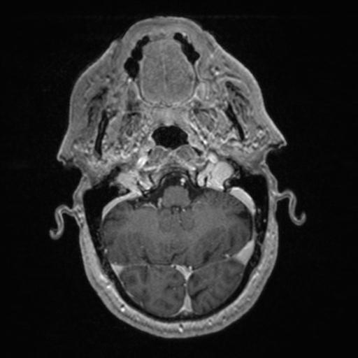 Atypical meningioma (grade II) - en plaque (Radiopaedia 29633-30147 Axial T1 C+ 42).jpg