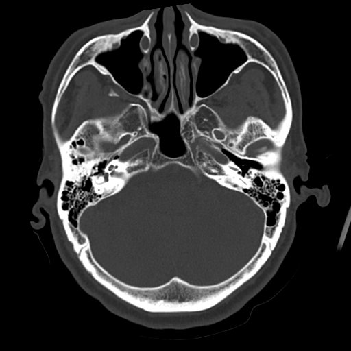 File:Atypical meningioma with skull invasion (Radiopaedia 34357-35649 Axial bone window 20).png