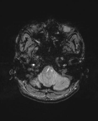 File:Autoimmune limbic encephalitis (Radiopaedia 30363-31005 SWI - magnitude 10).jpg