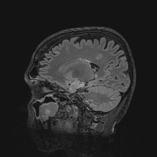 Autoimmune limbic encephalitis (Radiopaedia 30363-31005 Sagittal FLAIR 98).jpg