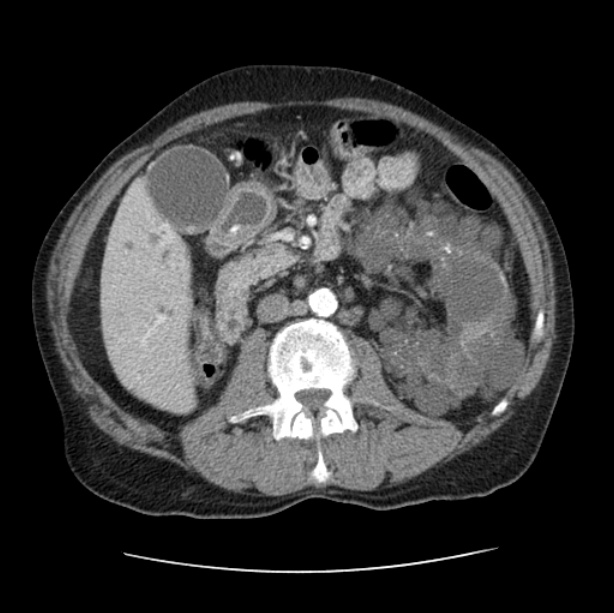 Autosomal dominant polycystic kidney disease (Radiopaedia 27851-28094 B 73).jpg