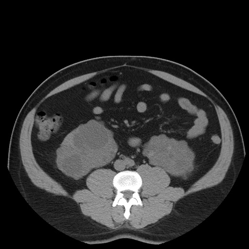 Autosomal dominant polycystic kidney disease (Radiopaedia 50259-55612 Axial non-contrast 49).jpg