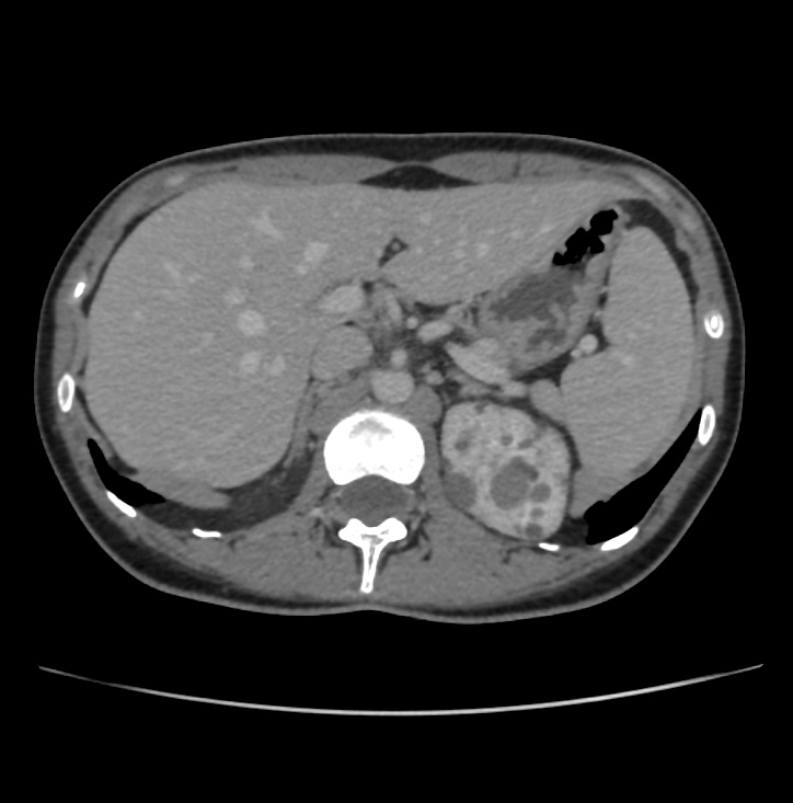 Autosomal dominant polycystic kidney disease - early onset (Radiopaedia 40734-43387 A 12).jpg