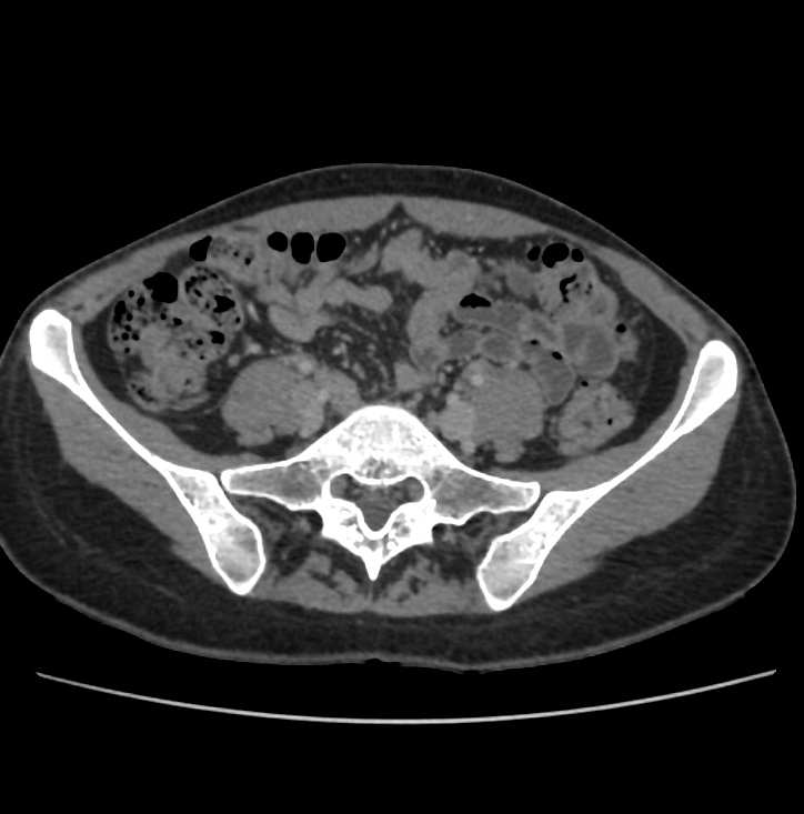 Autosomal dominant polycystic kidney disease - early onset (Radiopaedia 40734-43387 A 61).jpg