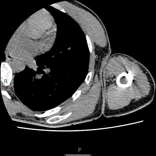File:Avascular necrosis after fracture dislocations of the proximal humerus (Radiopaedia 88078-104653 D 82).jpg