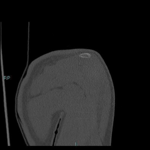 Avascular necrosis after fracture dislocations of the proximal humerus (Radiopaedia 88078-104655 Coronal bone window 43).jpg