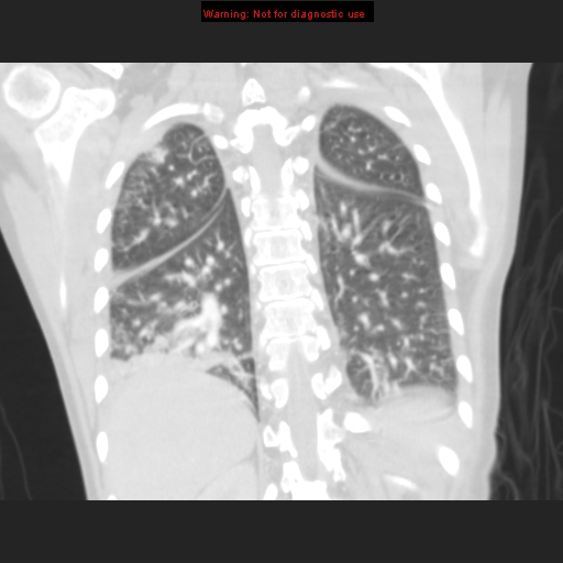 File:Avascular necrosis in sickle cell disease (Radiopaedia 17448-17152 B 96).jpg