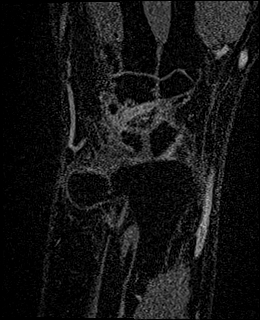 Avascular necrosis of the capitate (Radiopaedia 88317-104948 Coronal T1 vibe 18).jpg