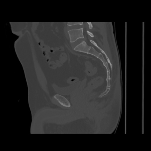 File:Avascular necrosis of the hip (Radiopaedia 61503-69467 B 32).jpg