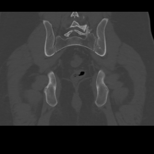 File:Avascular necrosis of the hip (Radiopaedia 61503-69467 Coronal bone window 30).jpg